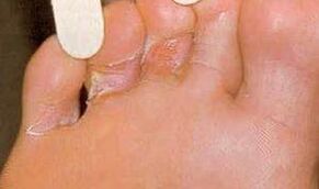 Dermaid Dermaid For Foot Mycosis